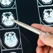Entenda as promessas do medicamento recém-aprovado para câncer cerebral - Freepik 