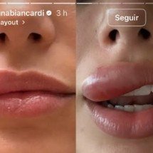 Bruna Biancardi tem inchaço na boca após espremer espinha, veja os riscos - Reprodução Instagram