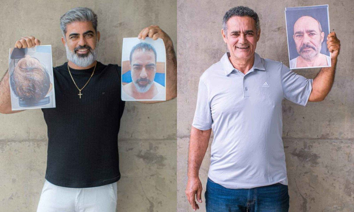 O transplante capilar evoluiu com técnicas menos invasivas, resultados naturais e alta procura, colocando o Brasil entre os líderes do setor no cenário global -  (crédito: Divulgação Clinica Rejuvenesce)