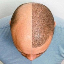 Personalização maximiza efeitos do transplante capilar - DINO