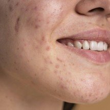 Skincare: como cuidar da pele com acne? - FreePik
