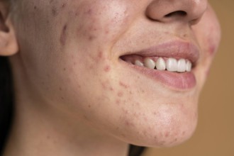 Skincare: como cuidar da pele com acne?