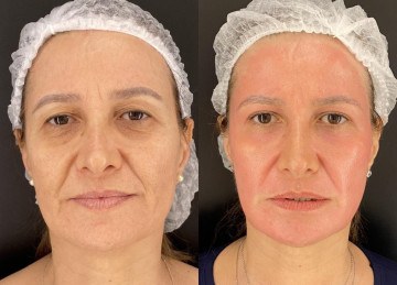 Mercado de medicina estética cresce e ganha força em Minas Gerais

 -  (crédito: Reprodução Instagram)