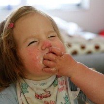 Alergias alimentares em crianças crescem no país e pedem atenção redobrada