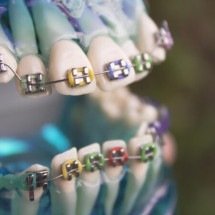 Aparelhos ortodônticos falsos viram modismo e preocupam especialistas - Freepik