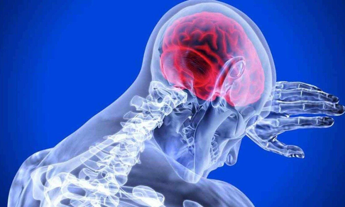 Número de mortes por AVC no país em 2024 foi de 85.427 óbitos, ante 77.886 causados por infarto, segundo a SBAVC
 -  (crédito: pixabay/reprodução)