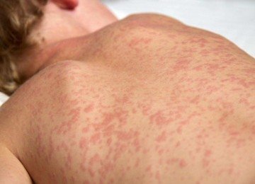 Criança com sarampo; imagem meramente ilustrativa -  (crédito: Reprodução/Ministério da Saúde)