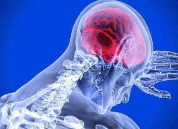 Número de mortes por AVC no país em 2024 foi de 85.427 óbitos, ante 77.886 causados por infarto, segundo a SBAVC
 -  (crédito: pixabay/reprodução)