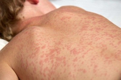 Criança com sarampo; imagem meramente ilustrativa -  (crédito: Reprodução/Ministério da Saúde)