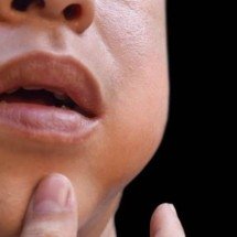 Caxumba: tudo sobre a doença que causa inchaço nas glândulas salivares - iStock