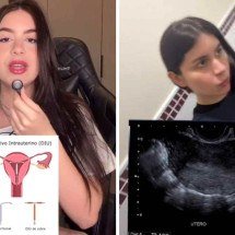 ‘Perdi meu DIU’: influenciadora conta que dispositivo desapareceu do útero