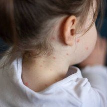Sarampo pode matar: sinais de alerta, formas de transmissão e prevenção - iStock