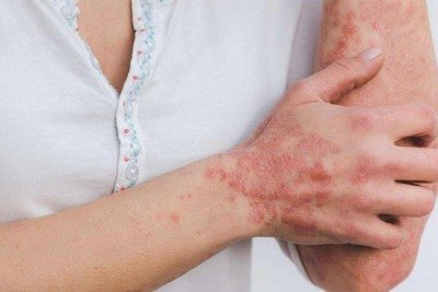 A psoríase é uma condição inflamatória crônica e sistêmica, que pode afetar órgãos internos, comprometer articulações -  (crédito: Eszter Miller/Pixabay)