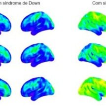 Neuroinflamação em síndrome de Down explica alta prevalência de Alzheimer  -  Daniele de Paula Faria/Laboratório de Medicina Nuclear, HC-FM-USP