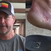 Bactéria 'comedora de carne': devo me preocupar? - Redes Sociais