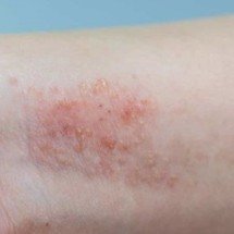 Pesquisadores desenvolvem novo medicamento para dermatite atópica - Ministério da Saúde via CTS-Cevap