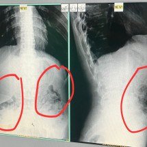 Detentos são flagrados ao tentar voltar a presídio com drogas no estômago - PMMG/Reprodução