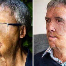 Impressão 3D revoluciona tratamento de ciclista que teve rosto desfigurado - SWNS