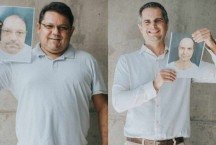 Transplante capilar: clínica de Belo Horizonte se destaca pela técnica FUE