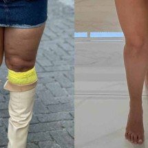 Lipedema: casos de Mirella Janis e Yasmin Brunet aliam treino e saúde - Instagram/Reprodução