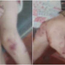 Caso Alice: imagens mostram ferimentos provocados por espancamento - Reprodução