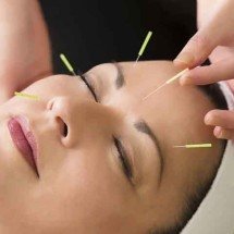 De que forma a Acupuntura pode ajudar na saúde e no bem-estar -  Flickr Cosmetic Acupuncture