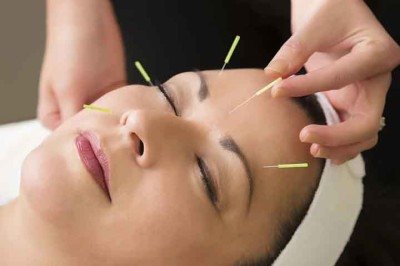 A acupuntura é uma técnica terapêutica da medicina tradicional chinesa que consiste na aplicação de agulhas em pontos específicos do corpo para estimular o equilíbrio energético e tratar diversas condições de saúde. -  (crédito:  Flickr Cosmetic Acupuncture)