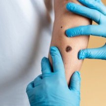 Câncer de pele: mutirão de atendimento gratuito ocorre neste sábado - FreePik