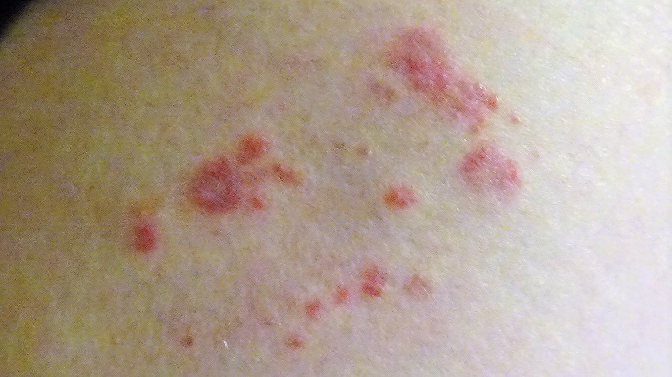 Cobreiro: o que é a herpes-zóster, quais os sintomas e como tratar - By Rosser1954 - Own work, CC BY-SA 4.0, https://commons.wikimedia.org/w/index.php?curid=74543904