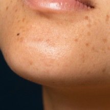 Melasma: como tratar de forma segura no verão - FreePik