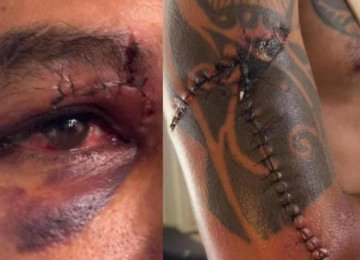 Gilliard Barbosa de Oliveira passou por cirurgia plástica, levou mais de 30 pontos no braço e 10 no supercílio, além de fazer uso contínuo de medicamentos para controle da dor -  (crédito: Redes sociais/reprodução)