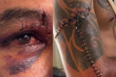 Gilliard Barbosa de Oliveira passou por cirurgia plástica, levou mais de 30 pontos no braço e 10 no supercílio, além de fazer uso contínuo de medicamentos para controle da dor -  (crédito: Redes sociais/reprodução)