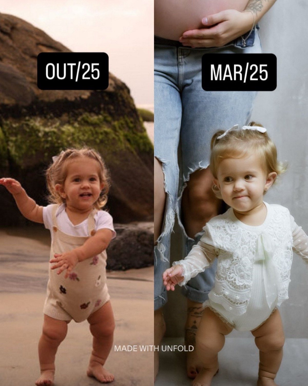 Com um ano do rem&eacute;dio, Bella cresceu 14 cent&iacute;metros, deixou de sentir dores nas penas, passou a dormir melhor e respirar sem o risco de apneia. As pernas desentortaram e o f&ecirc;mur cresceu cinco cent&iacute;metros