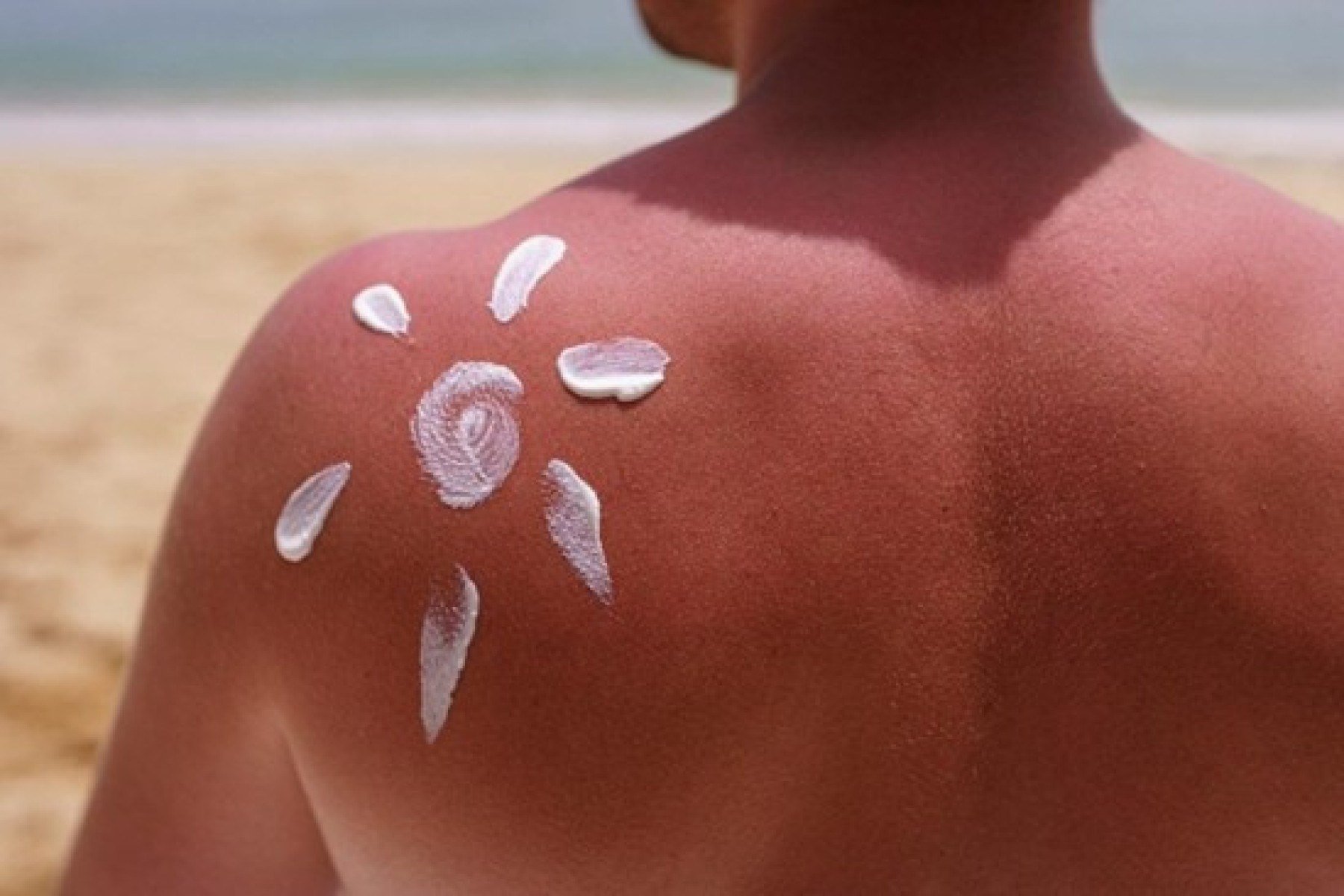 NoSunscreen: movimento viral preocupa especialistas - DINO
