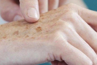 O melanoma (tipo mais grave de c&acirc;ncer)  aparece nos melan&oacute;citos, c&eacute;lulas respons&aacute;veis pela melanina, a pigmenta&ccedil;&atilde;o (cor) da pele -  (crédito: Ag&ecirc;ncia Brasil)
