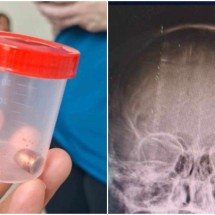 Menino é atingido por bala perdida durante virada do ano na Grande BH - TV Alterosa / Reprodução