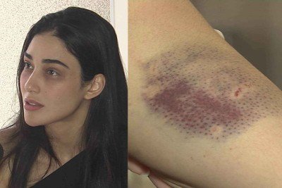 Pollyana teve hematomas por todo o corpo devido às agressões -  (crédito: TV Alterosa)