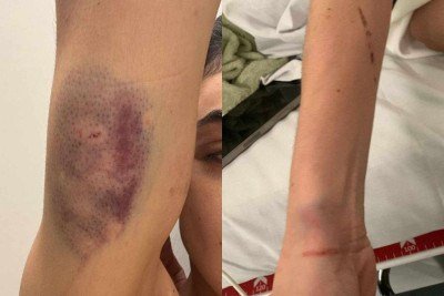 Jovem de 25 anos teve as roupas resgadas e sofreu ferimentos nos braços e costas -  (crédito: Arquivo pessoal)