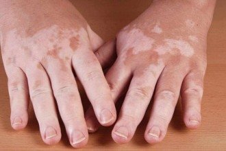 Vitiligo: causas, sintomas e como tratar as manchas na pele