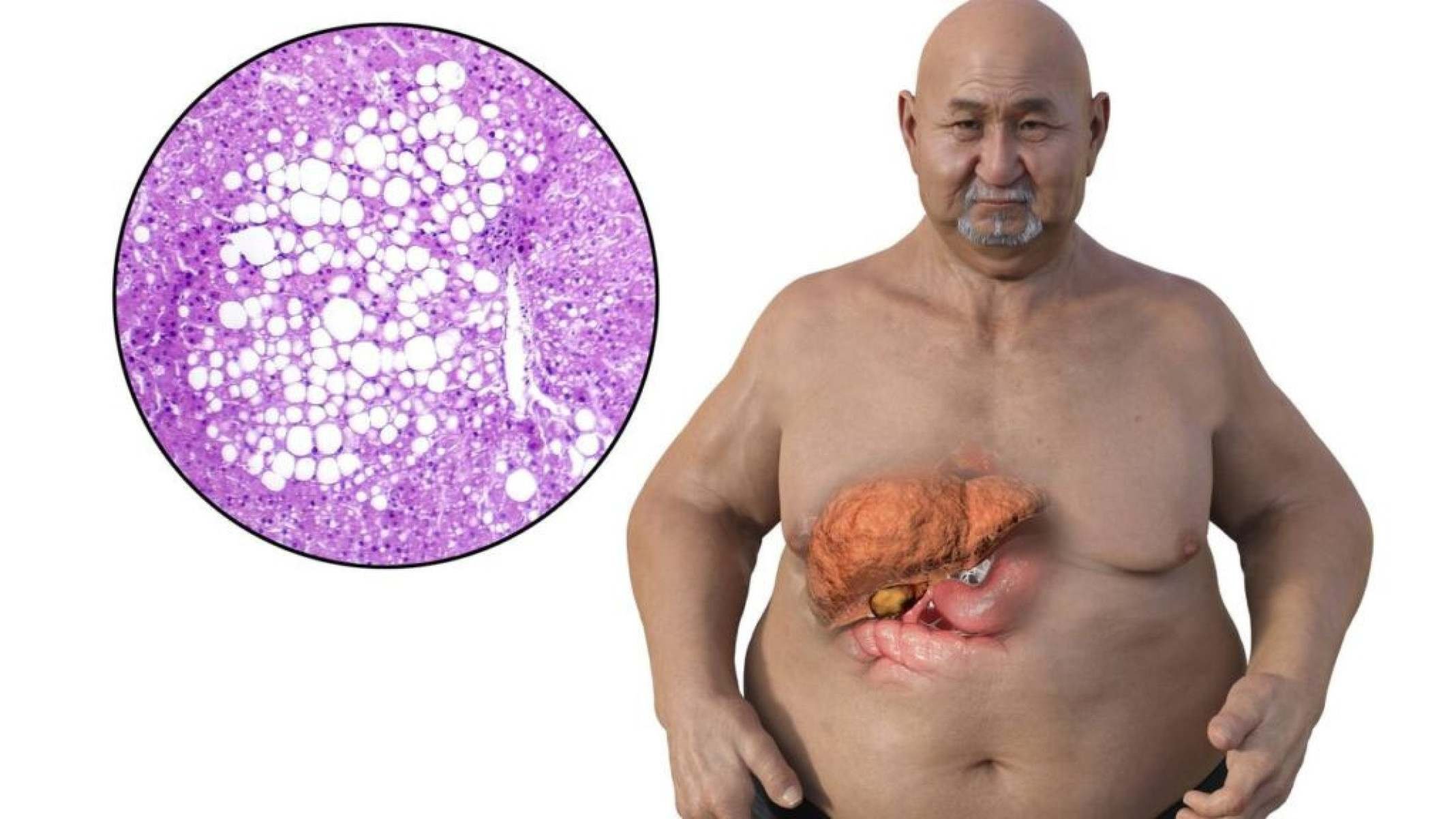 Esteatose Hepática: como a gordura se acumula no fígado - Portal Giro 10