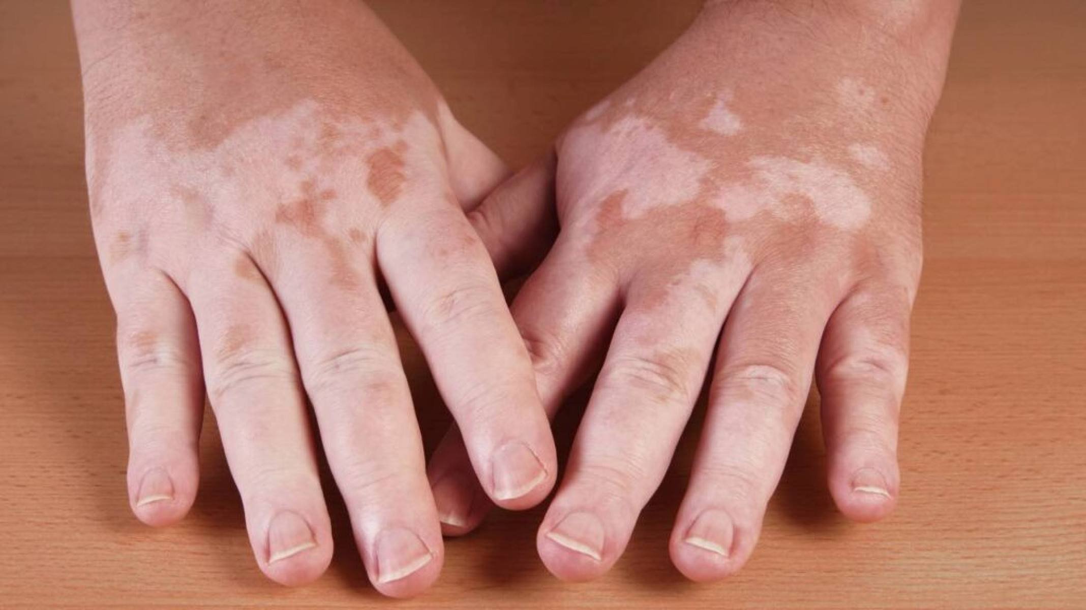Vitiligo: causas, sintomas e como tratar as manchas na pele - Portal Giro 10