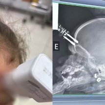 Menina de 1 ano cai em cima de carregador e fica com ele cravado na testa - Bruno Castro/Arquivo Pessoal