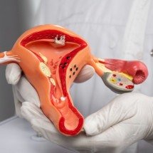 O que está por trás da síndrome dos ovários policísticos? - FreePik