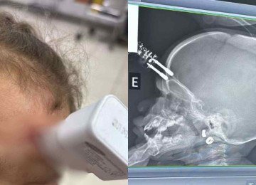 Criança caiu da cama em cima de um carregador de celular e precisou passar por cirurgia -  (crédito: Bruno Castro/Arquivo Pessoal)