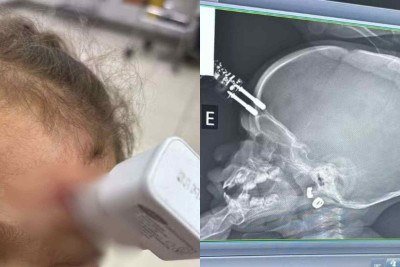 Criança caiu da cama em cima de um carregador de celular e precisou passar por cirurgia -  (crédito: Bruno Castro/Arquivo Pessoal)