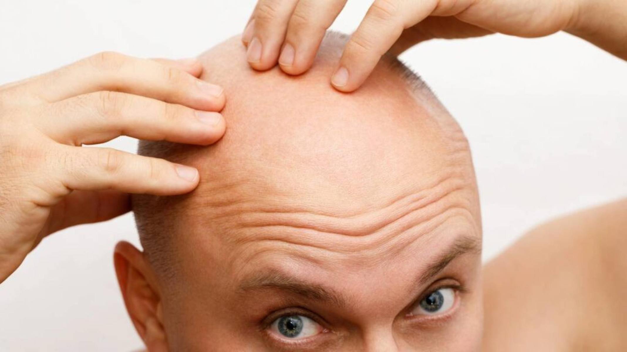 Finasterida e Minoxidil: avaliando riscos, efeitos colaterais e precauções médicas - Portal Giro 10