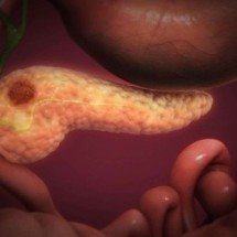 Estudo revela proteína ligada ao avanço do câncer de pâncreas pelos nervos