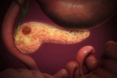 No Brasil, segundo estimativas do Instituto Nacional de Câncer (Inca), ocorrem cerca de 13 mil mortes por ano decorrentes desse tipo de tumor  -  (crédito: Scientific Animations/Wikimedia Commons)