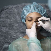 Desvio de septo: cirurgia corrige por dentro e pode aperfeiçoar por fora - Hospital Albert Einstein/divulgação