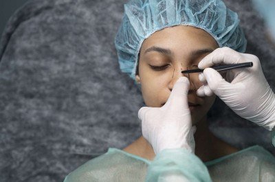 A cartilagem aproveitada como enxerto estrutural contribui para melhor sustentação nasal e resultados mais estáveis -  (crédito: Hospital Albert Einstein/divulgação)